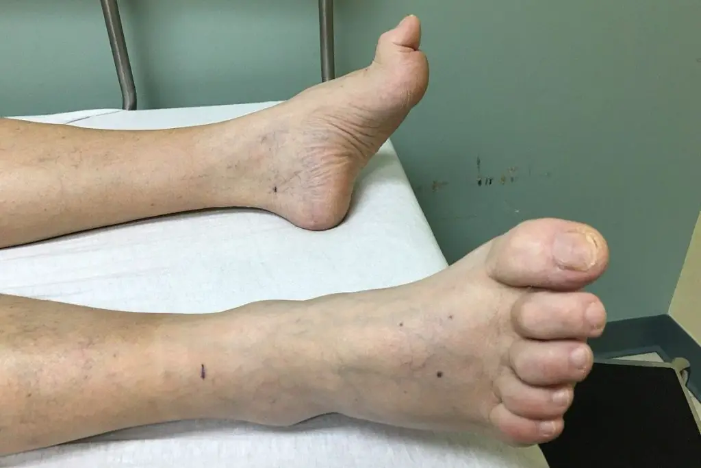 hammertoes