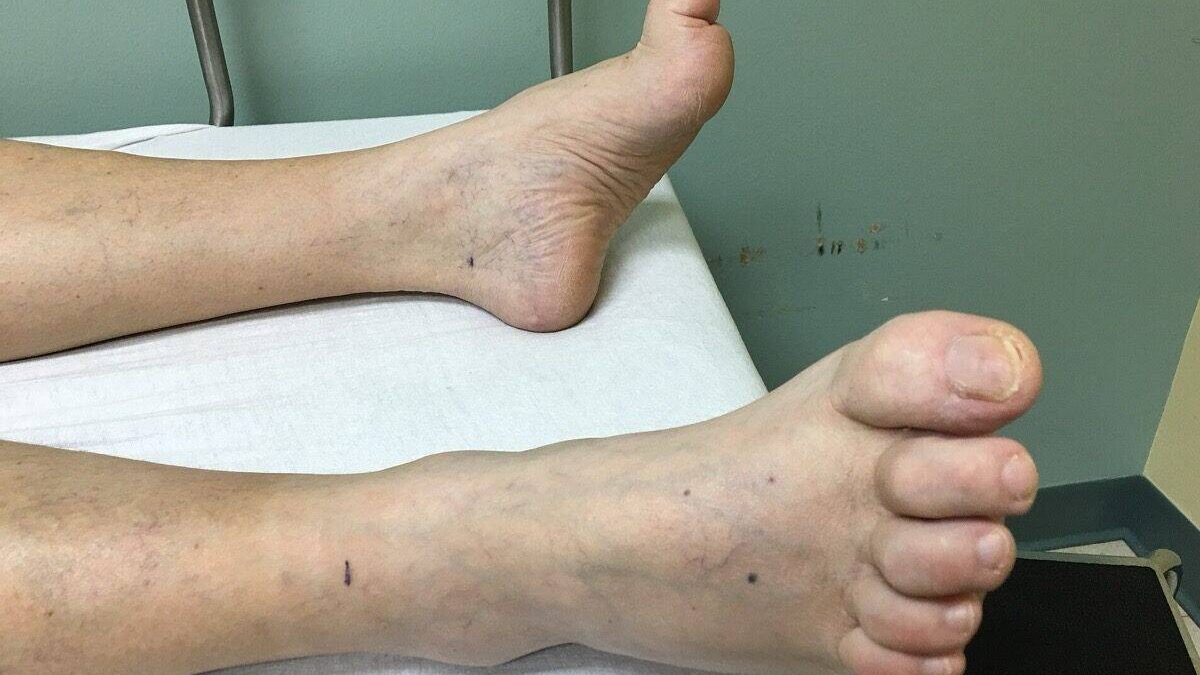 hammertoes