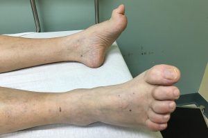 hammertoes