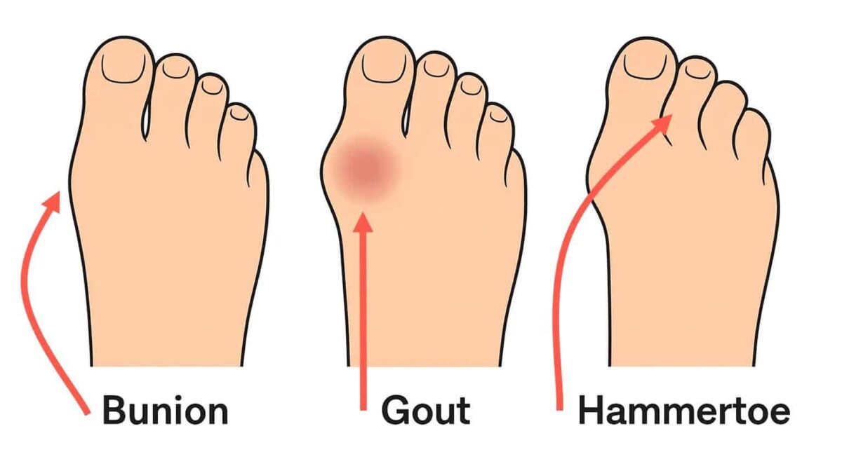 gout vs bunion vs hammertoe