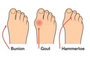 gout vs bunion vs hammertoe