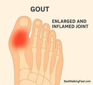 Gout