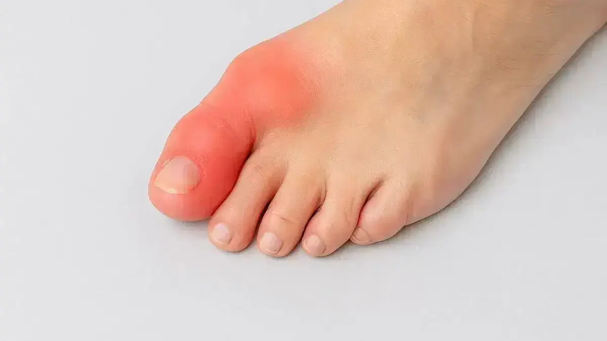 hallus rigidus foot