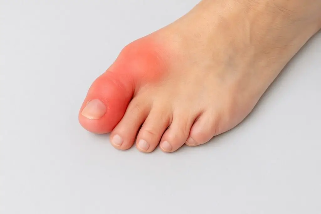 hallus rigidus foot