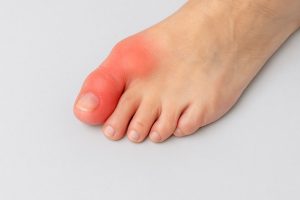 hallus rigidus foot