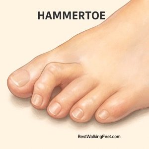 Hammertoe