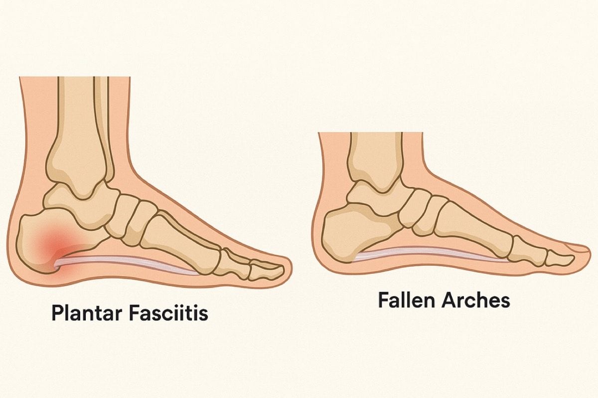 plantar fasciitis vs flat feet or fallen arches
