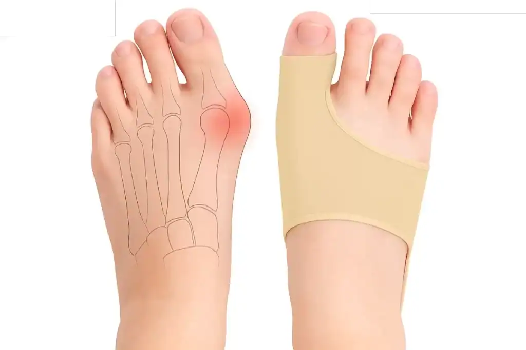 bunion remedy